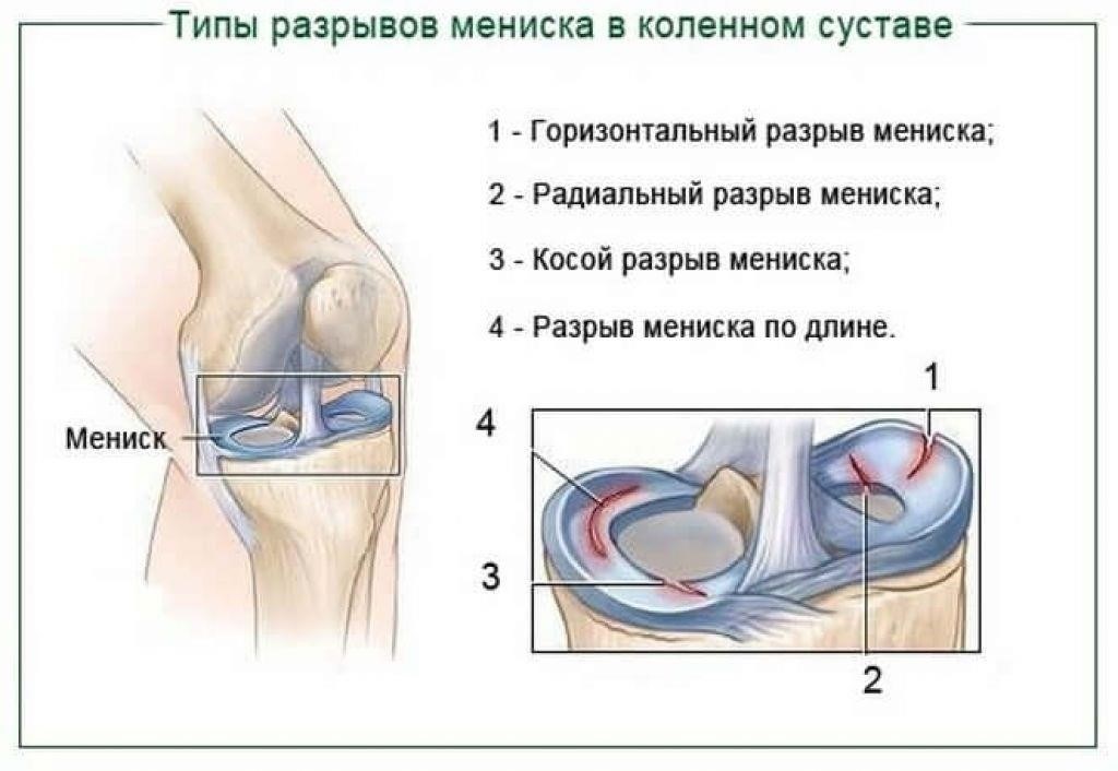 Понимание причин и последствий разрывов мениска